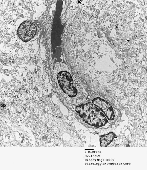 2I1 Mycoplasma Vasculopathy Leukoencephalopathy (Case 2) EM 1 - Copy