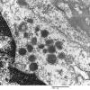 2I2 Mycoplasma Vasculopathy Leukoencephalopathy (Case 2) EM 3 - Copy