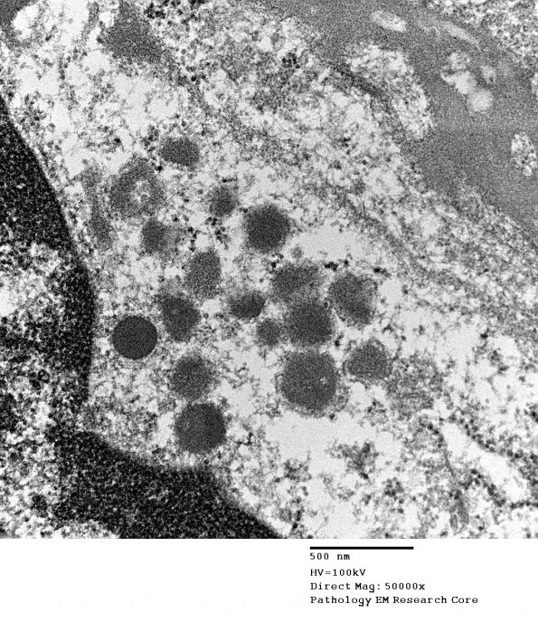 2I2 Mycoplasma Vasculopathy Leukoencephalopathy (Case 2) EM 3 - Copy