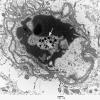 2I3 Mycoplasma Vasculopathy Leukoencephalopathy (Case 2) EM 6 - Copy copy