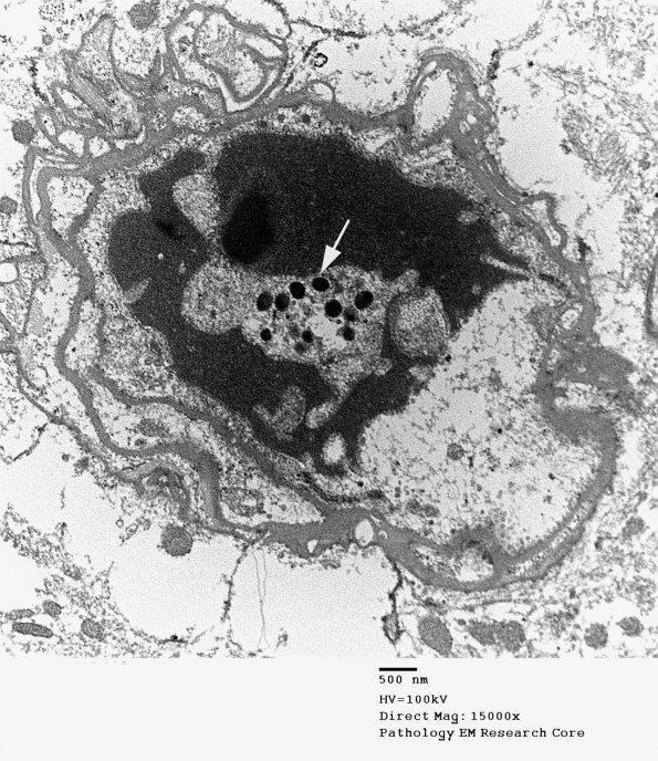 2I3 Mycoplasma Vasculopathy Leukoencephalopathy (Case 2) EM 6 - Copy copy