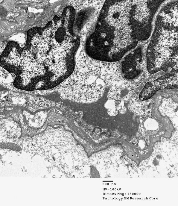 2I5 Mycoplasma Vasculopathy Leukoencephalopathy (Case 2) EM S12-4197-G_003 - Copy