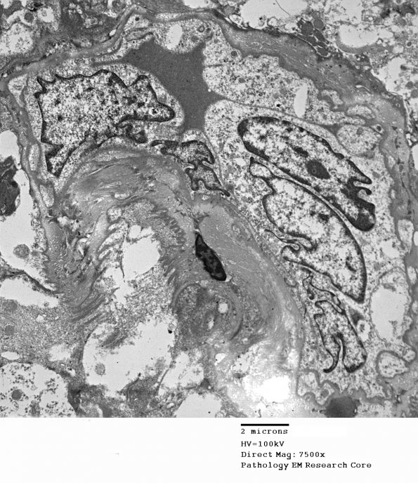 2I6 Mycoplasma Vasculopathy Leukoencephalopathy (Case 2) EM S12-4197-G_005 - Copy