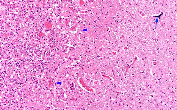 3B1 Megakaryocytic thrombi (Case 3) H&E 6 copy copy