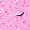 3B2 Megakaryocytic thrombi (Case 3) H&E 5