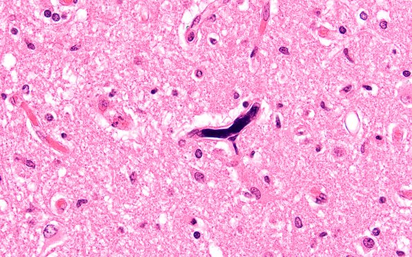 3B2 Megakaryocytic thrombi (Case 3) H&E 5