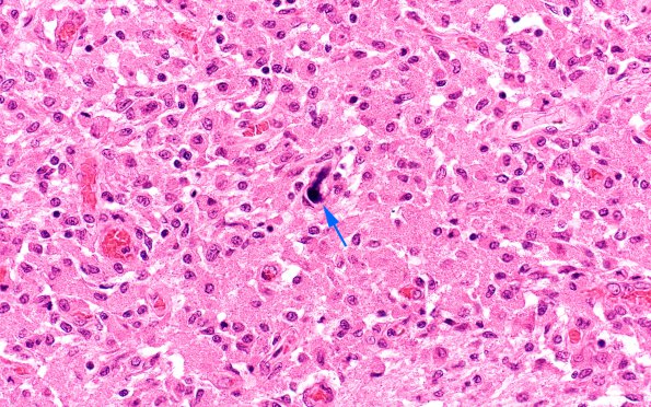 3B3 Megakaryocytic thrombi (Case 3) H&E 3 copy