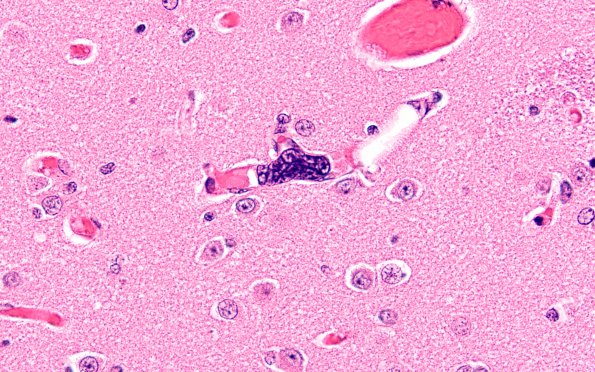 3B4 Megakaryocytic thrombi (Case 3) H&E 1