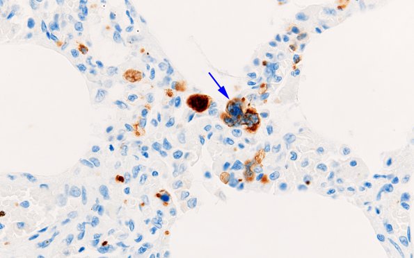 3C1 Megakaryocytic thrombi (Case 3) lung CD61 2 copy