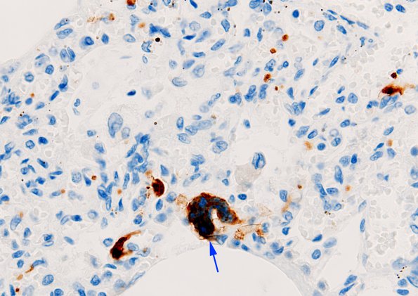 3C2 Megakaryocytic thrombi (Case 3) lung CD61 3 copy