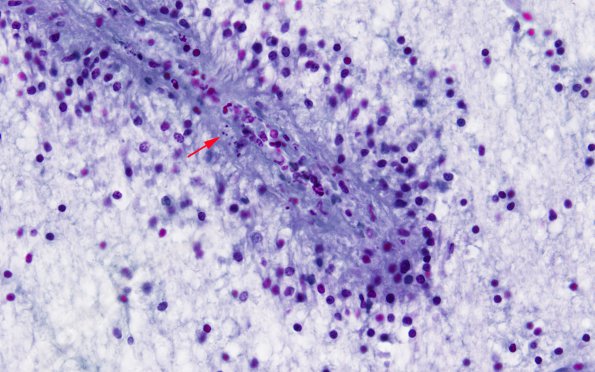 1B3 RMSF (Case 1) cortex Pinkerton stain for Rickettsia 2 copy