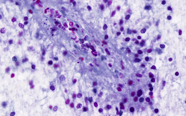 1B4 RMSF (Case 1) cortex Pinkerton stain for Rickettsia 5