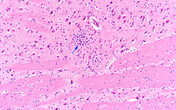 1C1 RMSF (Case 1) H&E pons 2 copy