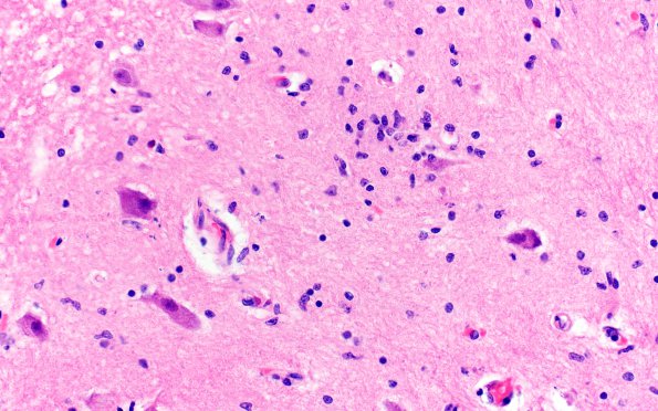 1C2 RMSF (Case 1) H&E Medulla 6