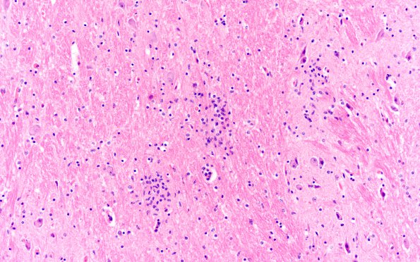 1C4 RMSF (Case 1) H&E Medulla 2 (2)