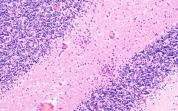 1C5 RMSF (Case 1) H&E cbell