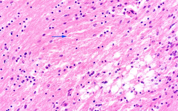 1D4 RMSF (Case 1) H&E cerebral cortex 3 copy