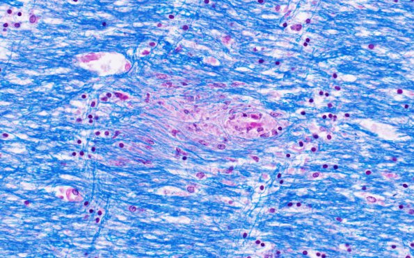 2C1 RMSF (Case 2) LFB-PAS 40X