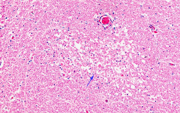 2D1 RMSF (Case 2) H&E 40X 6 copy