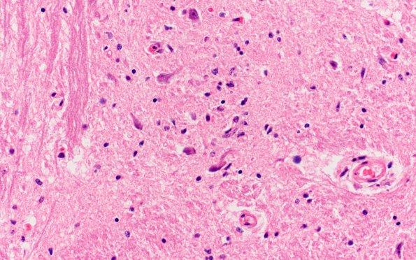 2E2 RMSF (Case 2) medulla H&E 1