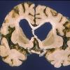 1A3 Syphilis, general paresis (Case 1, thanks to Ron Kim)