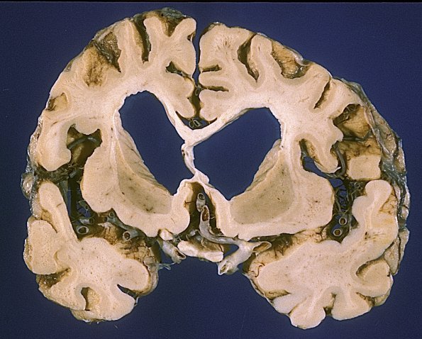 1A3 Syphilis, general paresis (Case 1, thanks to Ron Kim)