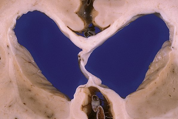1A4 Syphilis, general paresis (Case 1, thanks to Ron Kim)