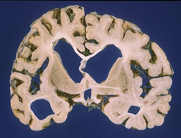 1A5 Syphilis, general paresis (Case 1, thanks to Ron Kim)