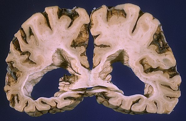 1A6 Syphilis, general paresis (Case 1, thanks to Ron Kim)