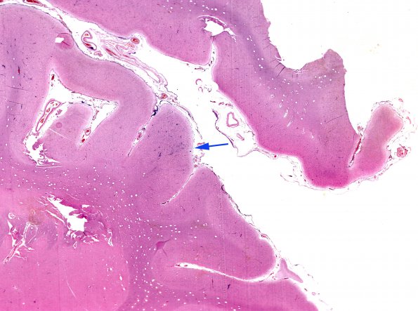 2A1 Syphilis, secondary (Case 2) H&E whole mount copy