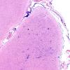 2A2 Syphilis, secondary (Case 2) H&E 1