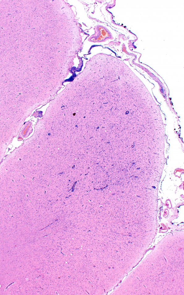 2A2 Syphilis, secondary (Case 2) H&E 1