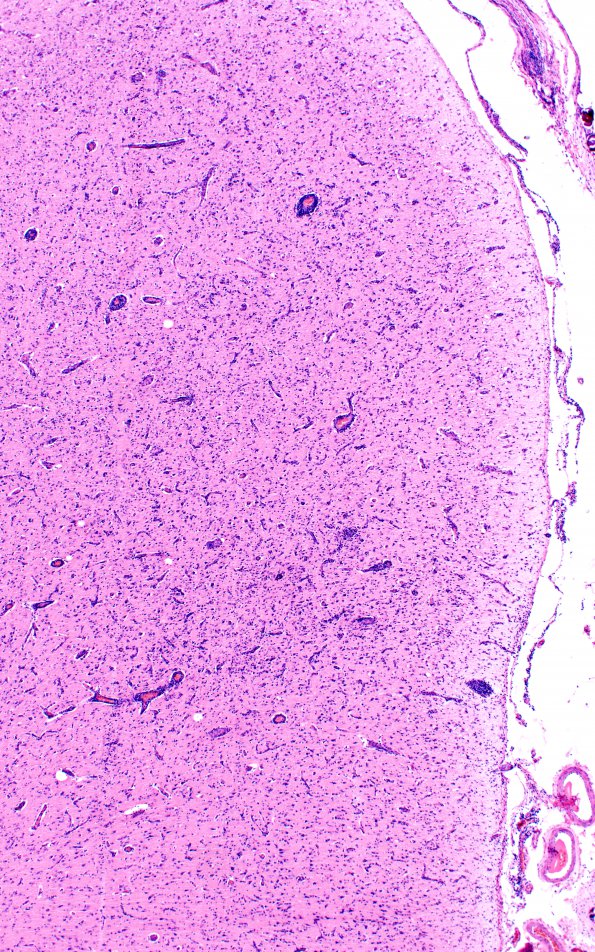 2A3 Syphilis, secondary (Case 2) H&E 3