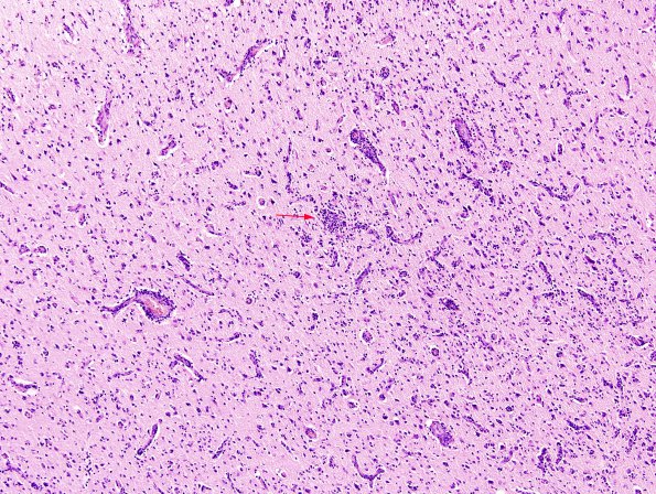 2A4 Syphilis, secondary (Case 2) H&E 6A copy