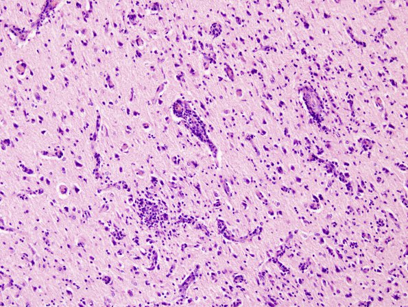 2A5 Syphilis, secondary (Case 2) H&E 7