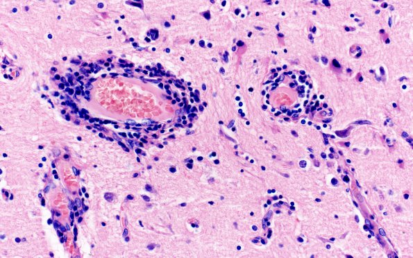 2A6 Syphilis, secondary (Case 2) H&E 14