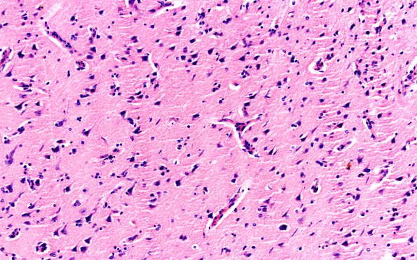 2A7 Syphilis, secondary (Case 2) H&E 15