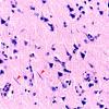 2A8 Syphilis, secondary (Case 2) H&E 16 copy