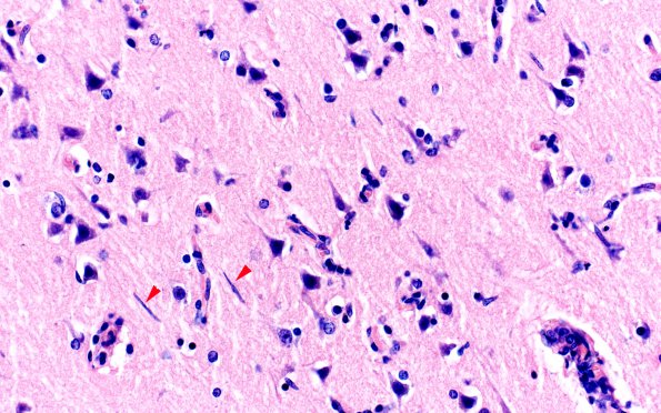 2A8 Syphilis, secondary (Case 2) H&E 16 copy