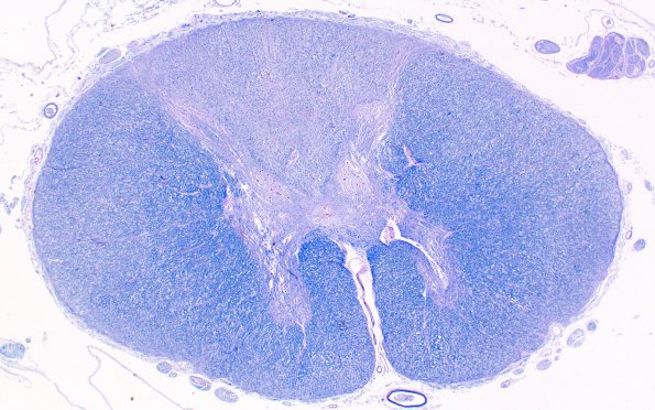 3B1 Tabes dorsalis, spinal cord (Case 3) LFB-PAS 1