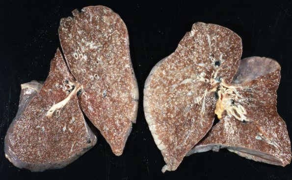 1A TB Meningitis, Ventriculitis, Tuberculoma, Rich foci (Case 1) Gross_5