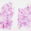 1C1 TB (Case 1) Lung 1 H&E 3 copy