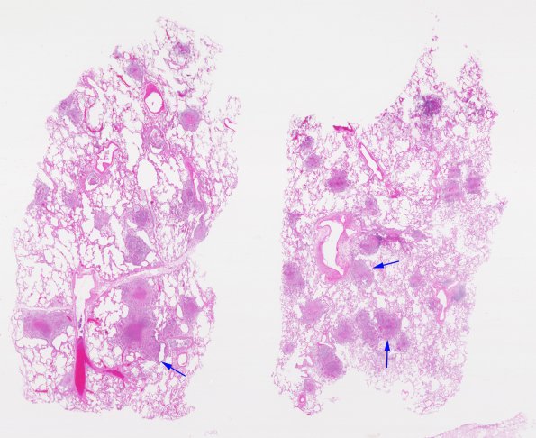 1C1 TB (Case 1) Lung 1 H&E 3 copy