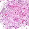 1C2 TB (Case 1) Lung 1 H&E 5