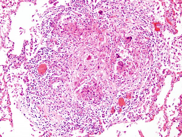 1C2 TB (Case 1) Lung 1 H&E 5