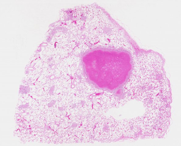 1C3 TB (Case 1) Lung 2 H&E whole mount