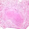 1C4 TB (Case 1) Lung 1 H&E 4A