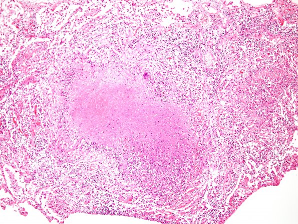 1C4 TB (Case 1) Lung 1 H&E 4A