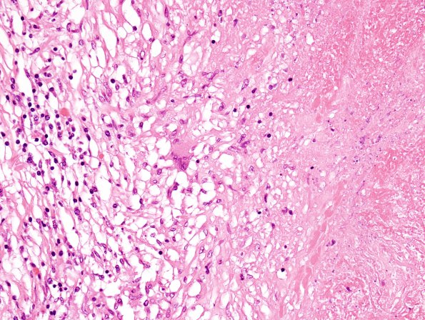 1C5 TB (Case 1) Lung 1 H&E 1A