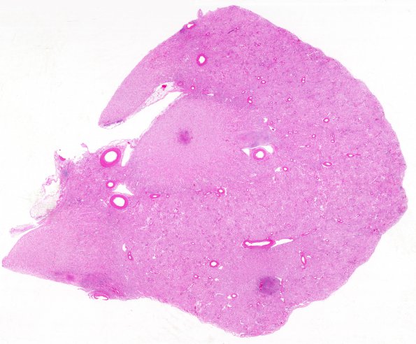 1D1 TB (Case 1) Kidney H&E whole mount